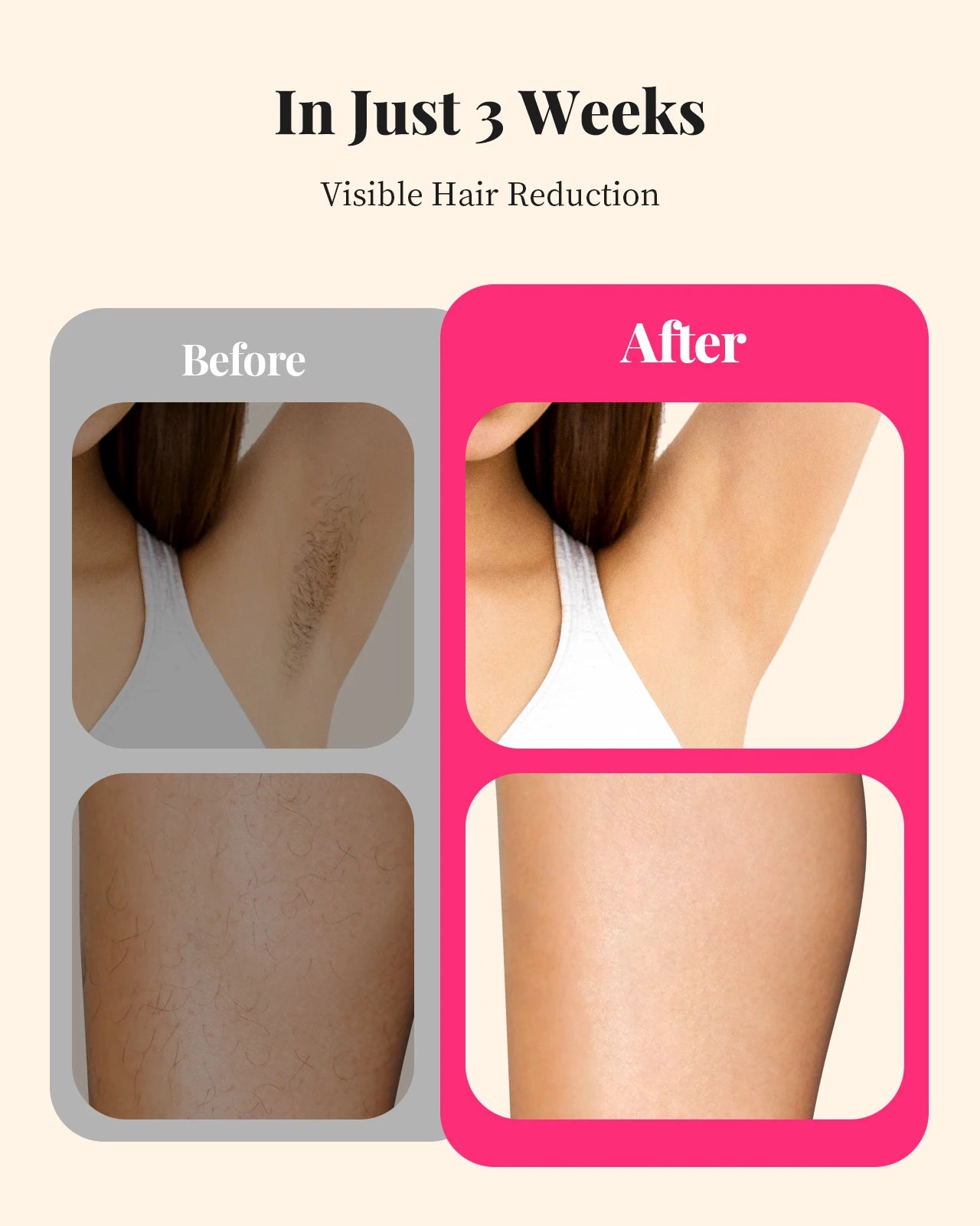 990,000 Flashes IPL Laser Hair Removal Device – Painless Permanent Hair Removal for Women & Men